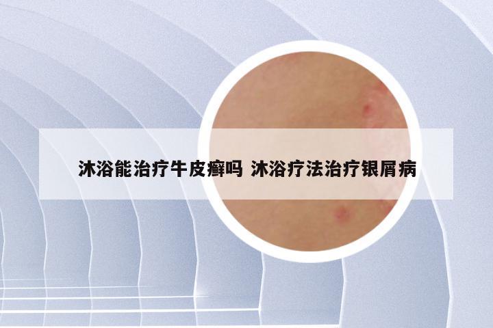 沐浴能治疗牛皮癣吗 沐浴疗法治疗银屑病