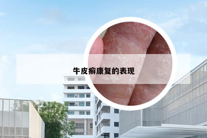 牛皮癣康复的表现