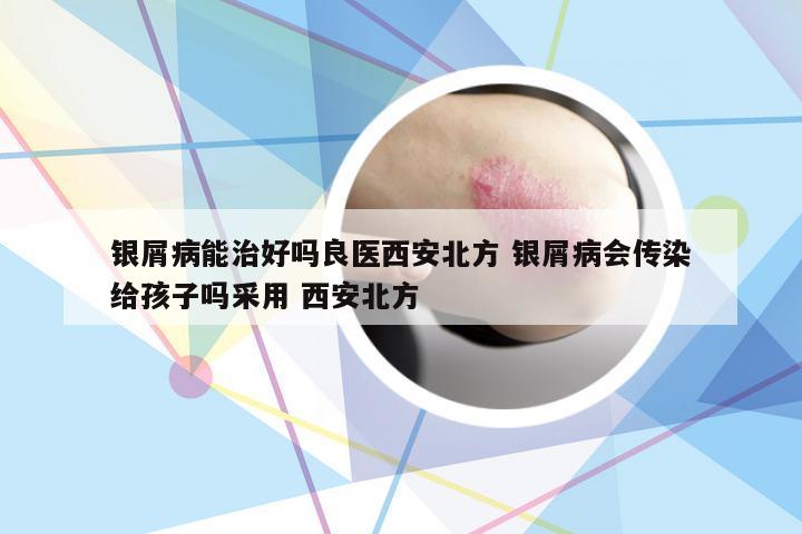 银屑病能治好吗良医西安北方 银屑病会传染给孩子吗采用 西安北方