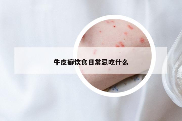 牛皮癣饮食日常忌吃什么