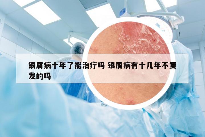 银屑病十年了能治疗吗 银屑病有十几年不复发的吗