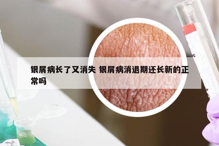 银屑病长了又消失 银屑病消退期还长新的正常吗