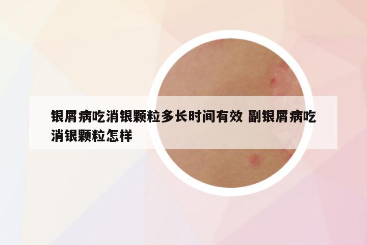 银屑病吃消银颗粒多长时间有效 副银屑病吃消银颗粒怎样