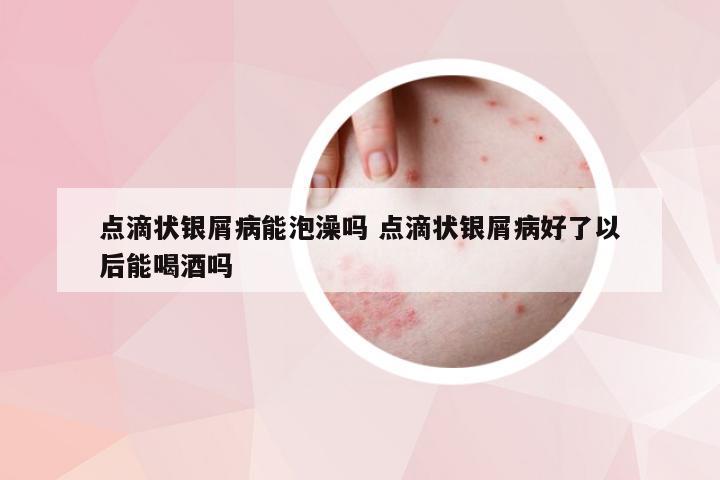 点滴状银屑病能泡澡吗 点滴状银屑病好了以后能喝酒吗
