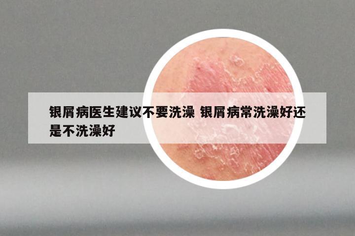 银屑病医生建议不要洗澡 银屑病常洗澡好还是不洗澡好