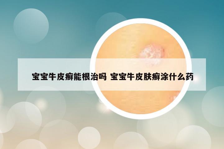 宝宝牛皮癣能根治吗 宝宝牛皮肤癣涂什么药