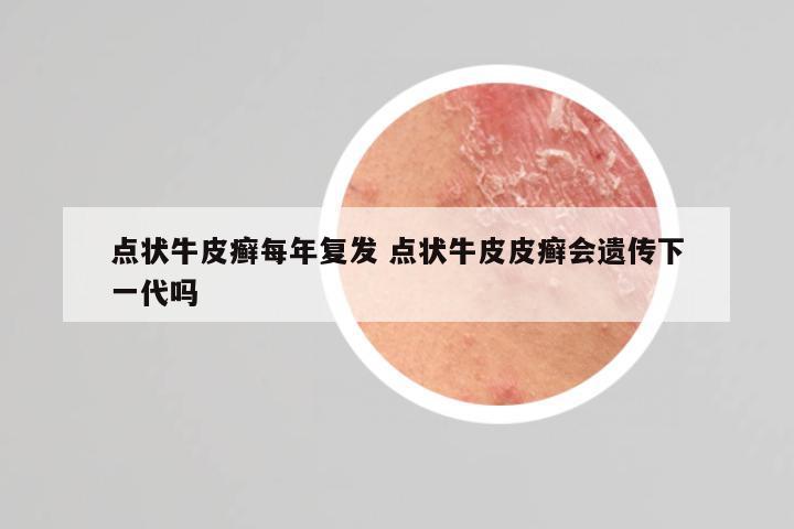 点状牛皮癣每年复发 点状牛皮皮癣会遗传下一代吗