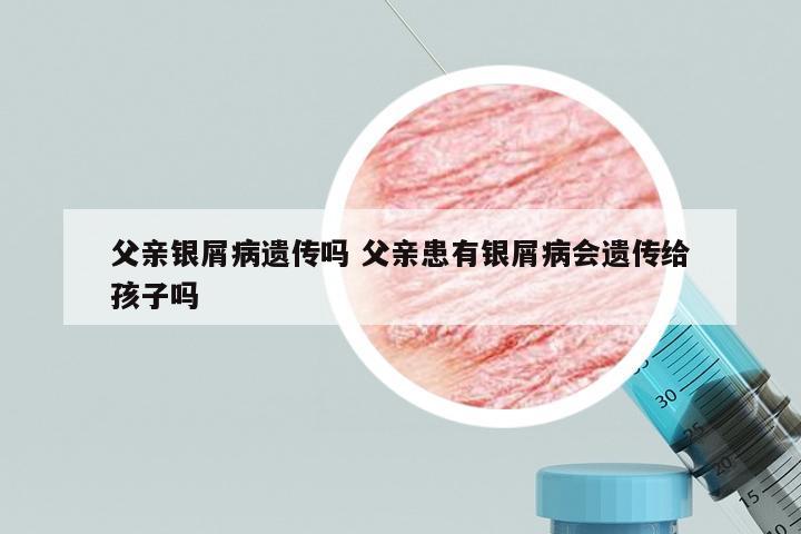 父亲银屑病遗传吗 父亲患有银屑病会遗传给孩子吗