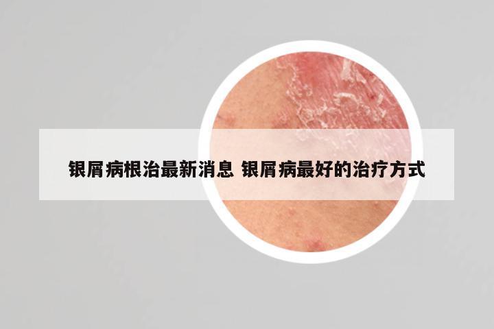 银屑病根治最新消息 银屑病最好的治疗方式