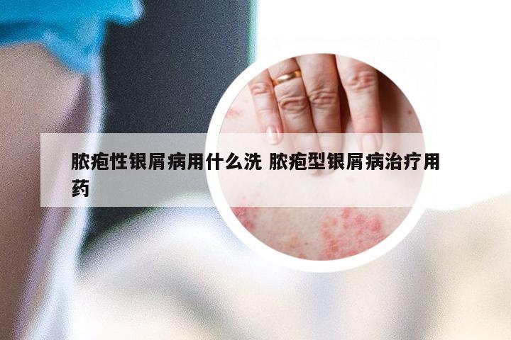 脓疱性银屑病用什么洗 脓疱型银屑病治疗用药