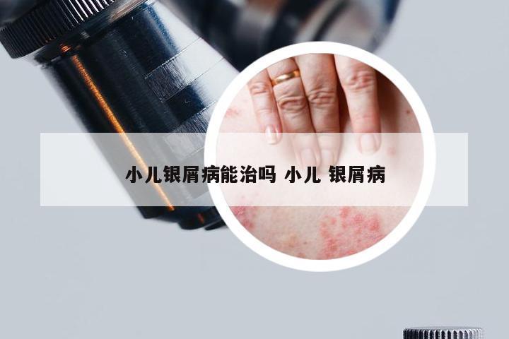 小儿银屑病能治吗 小儿 银屑病
