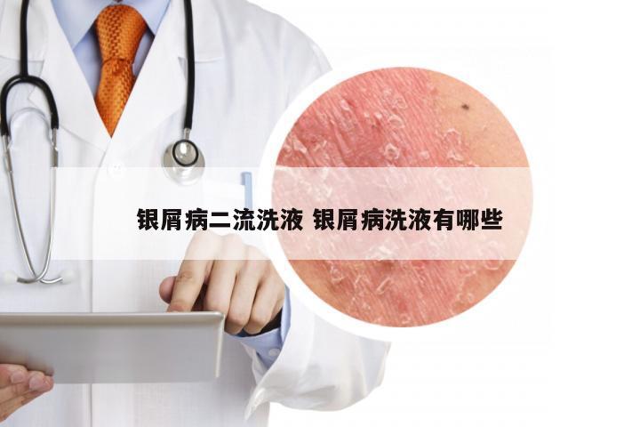 银屑病二流洗液 银屑病洗液有哪些