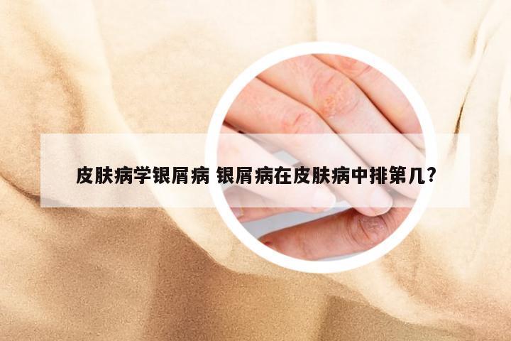 皮肤病学银屑病 银屑病在皮肤病中排第几?