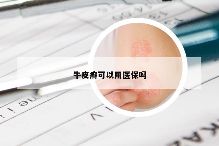 牛皮癣可以用医保吗