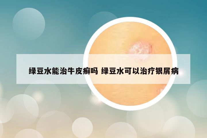 绿豆水能治牛皮癣吗 绿豆水可以治疗银屑病