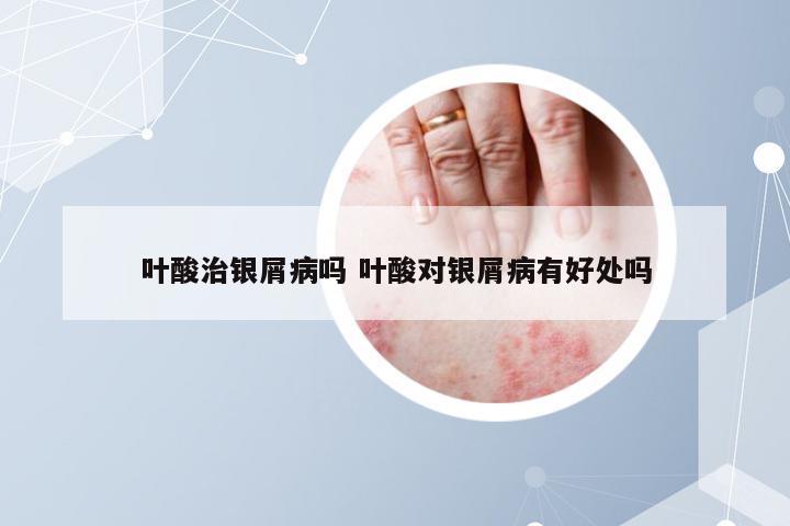 叶酸治银屑病吗 叶酸对银屑病有好处吗