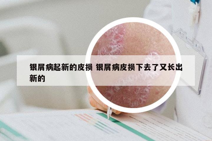 银屑病起新的皮损 银屑病皮损下去了又长出新的