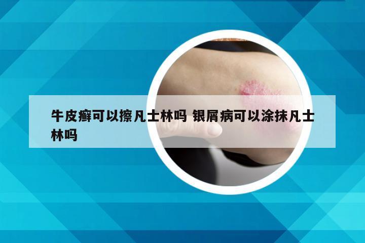 牛皮癣可以擦凡士林吗 银屑病可以涂抹凡士林吗