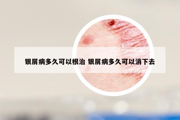 银屑病多久可以根治 银屑病多久可以消下去