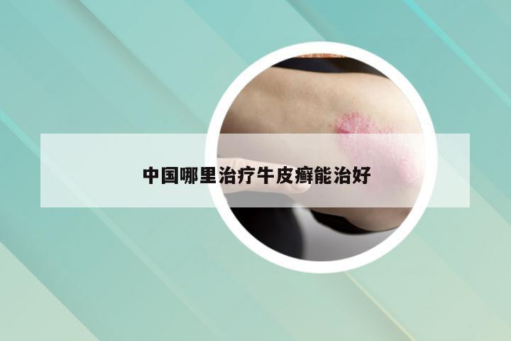 中国哪里治疗牛皮癣能治好
