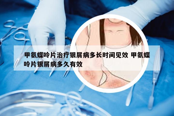 甲氨蝶呤片治疗银屑病多长时间见效 甲氨蝶呤片银屑病多久有效