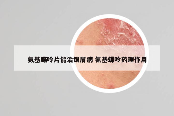 氨基喋呤片能治银屑病 氨基蝶呤药理作用