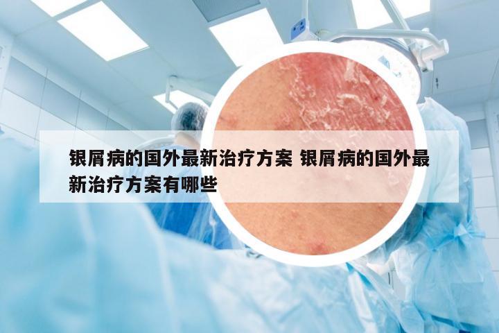 银屑病的国外最新治疗方案 银屑病的国外最新治疗方案有哪些