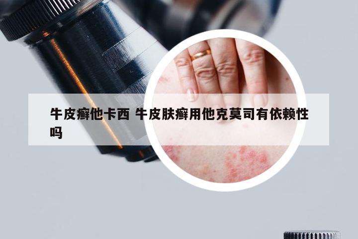 牛皮癣他卡西 牛皮肤癣用他克莫司有依赖性吗