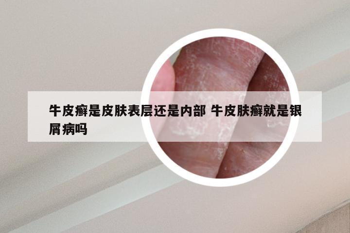 牛皮癣是皮肤表层还是内部 牛皮肤癣就是银屑病吗