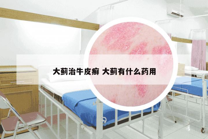 大蓟治牛皮癣 大蓟有什么药用