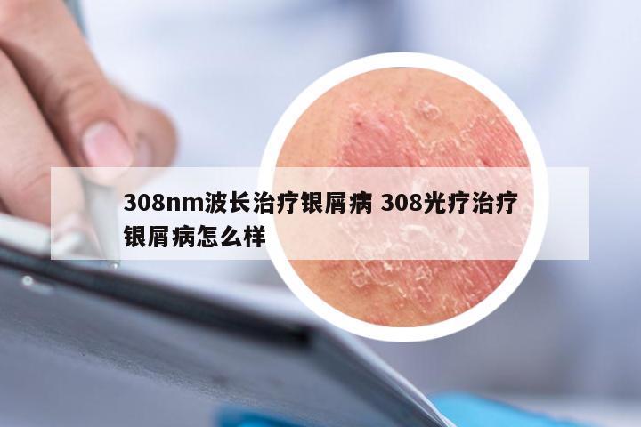 308nm波长治疗银屑病 308光疗治疗银屑病怎么样