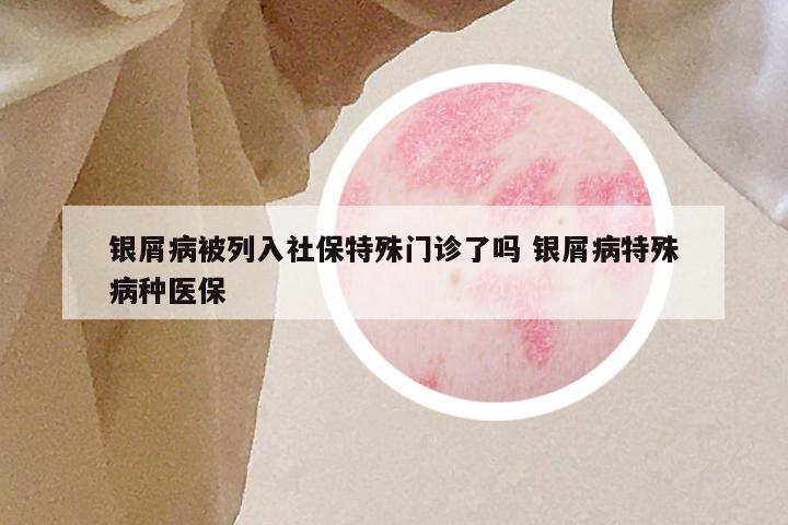 银屑病被列入社保特殊门诊了吗 银屑病特殊病种医保