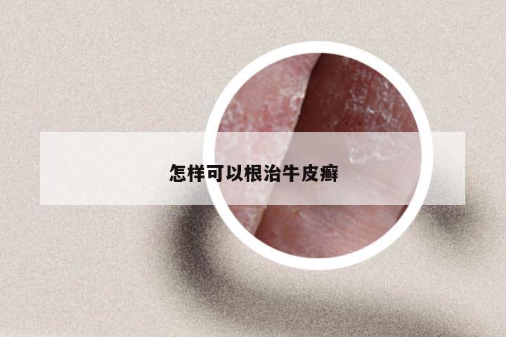 怎样可以根治牛皮癣