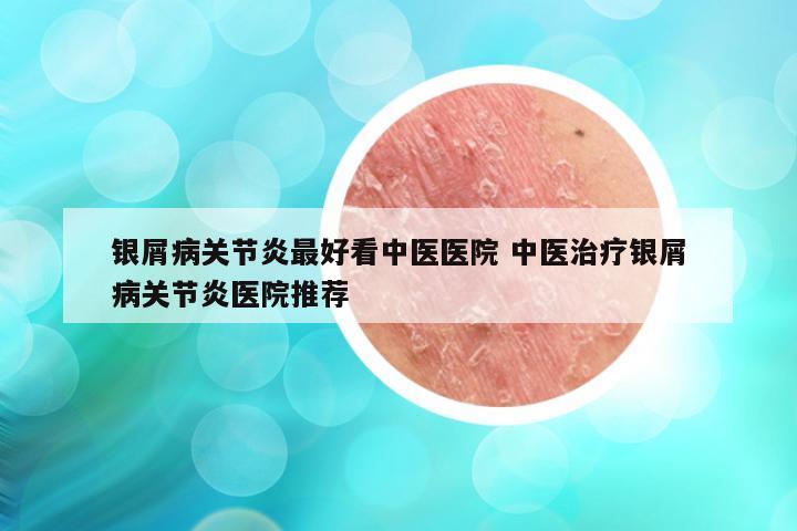 银屑病关节炎最好看中医医院 中医治疗银屑病关节炎医院推荐
