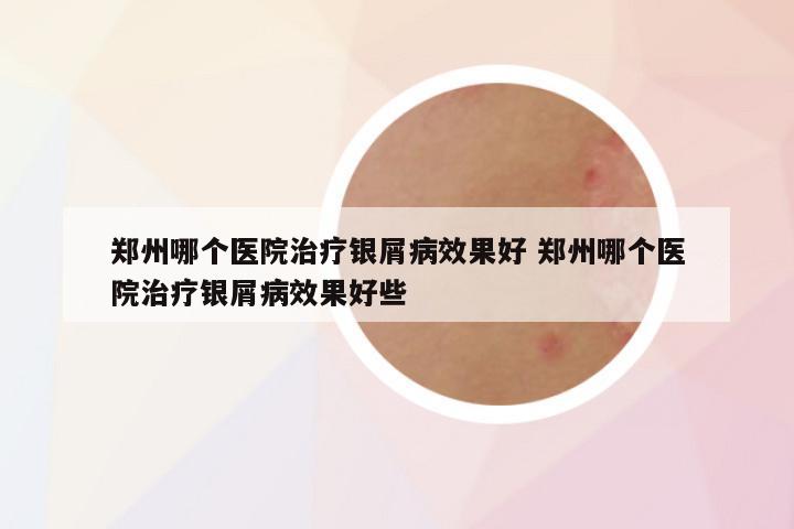 郑州哪个医院治疗银屑病效果好 郑州哪个医院治疗银屑病效果好些