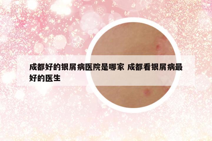 成都好的银屑病医院是哪家 成都看银屑病最好的医生
