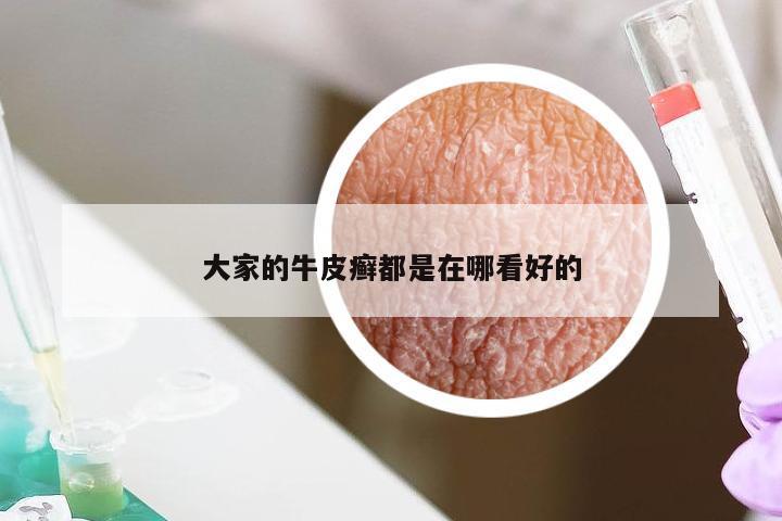大家的牛皮癣都是在哪看好的
