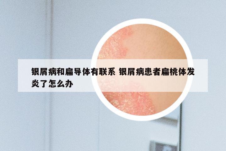 银屑病和扁导体有联系 银屑病患者扁桃体发炎了怎么办