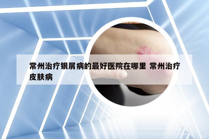 常州治疗银屑病的最好医院在哪里 常州治疗皮肤病