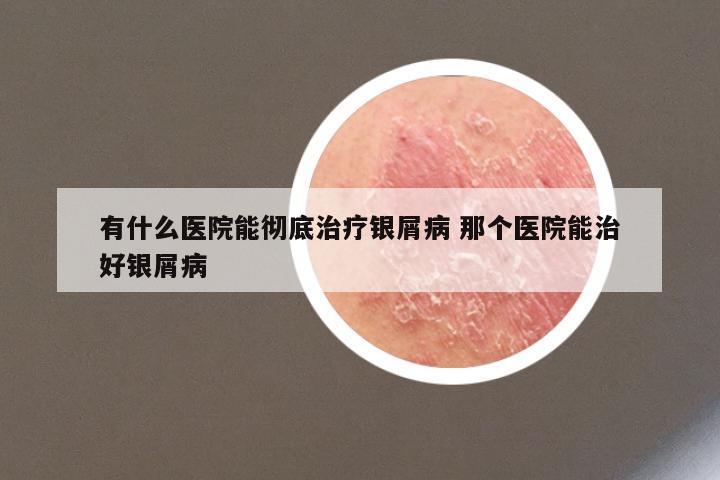 有什么医院能彻底治疗银屑病 那个医院能治好银屑病