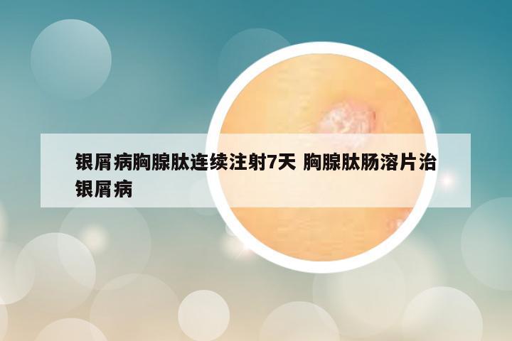 银屑病胸腺肽连续注射7天 胸腺肽肠溶片治银屑病