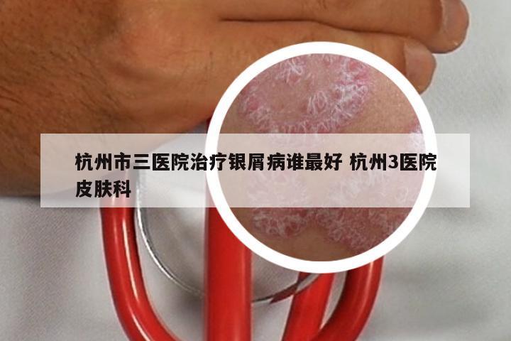 杭州市三医院治疗银屑病谁最好 杭州3医院皮肤科