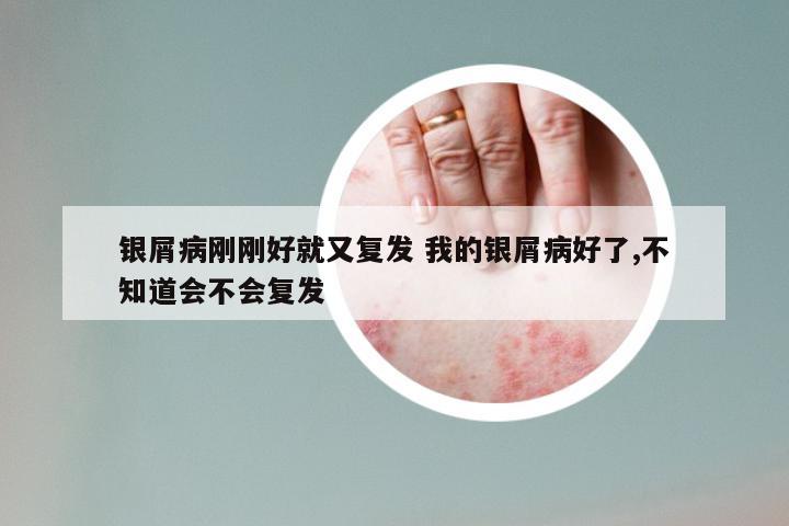 银屑病刚刚好就又复发 我的银屑病好了,不知道会不会复发