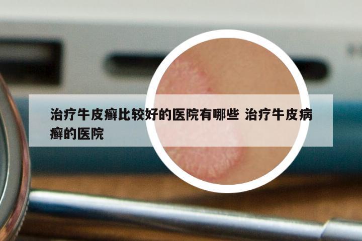 治疗牛皮癣比较好的医院有哪些 治疗牛皮病癣的医院