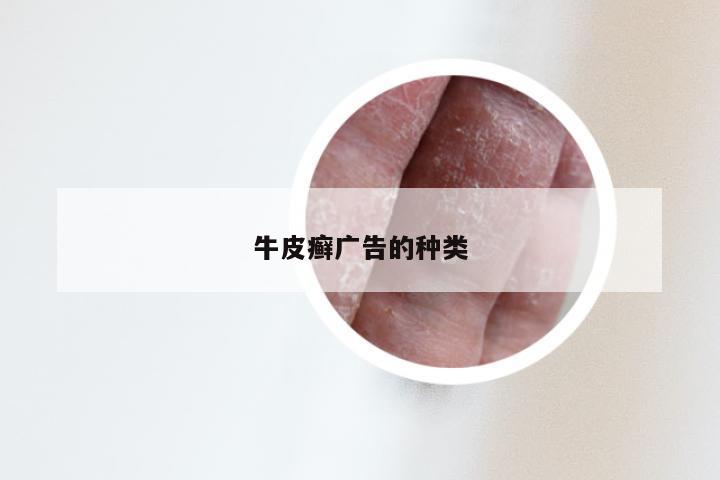 牛皮癣广告的种类