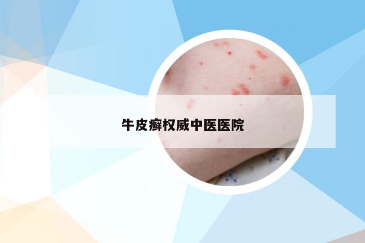 牛皮癣权威中医医院