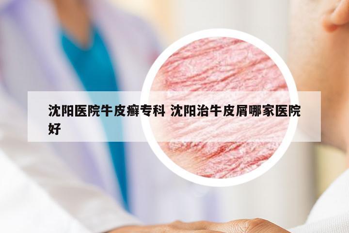沈阳医院牛皮癣专科 沈阳治牛皮屑哪家医院好
