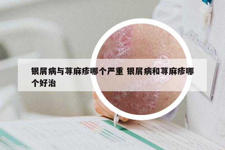 银屑病与荨麻疹哪个严重 银屑病和荨麻疹哪个好治