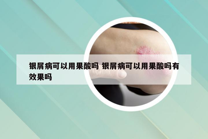 银屑病可以用果酸吗 银屑病可以用果酸吗有效果吗