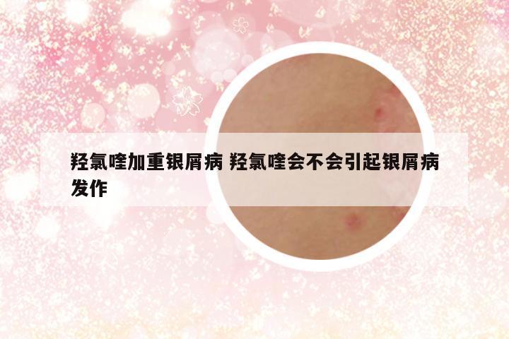 羟氯喹加重银屑病 羟氯喹会不会引起银屑病发作